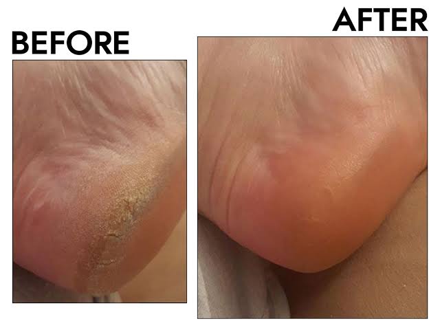 Callus Remover, Foot File Callus Remover