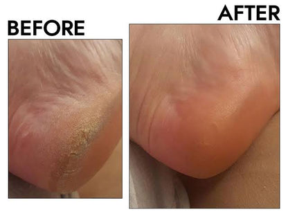 Callus Remover, Foot File Callus Remover